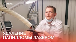 Удаление папилломы лазером в Дзержинске