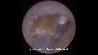 Large Plug of Ear Wax wrestled out of ear!!