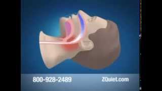 Why Do People Snore | How Do I Stop Snoring | How Can I Stop Snoring