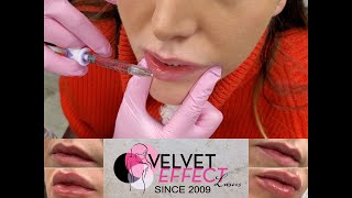 Lip Enhancement ??* Video ? # 57