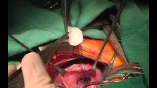 Fechamento de comunicação interventricular muscular de via de entrada do ventrículo direito