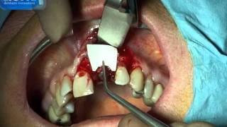 actis dentaire formation : avulsion implantation immédiate ROG (immediate implant placement GBR)