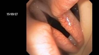 Veterinary Bronchoscopy#452, Laryngeal Paralysis Standard Poodle 11y