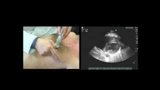 Basic TTE Video Tutorial