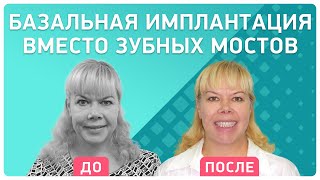 Новые зубы за 3 дня. Отзыв пациентки о базальной имплантации в клинике Smile-at-Once