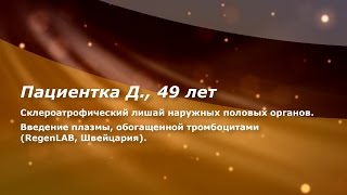 PRP в гинекологии. Склероатрофический лишай наружных половых органов.