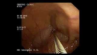Worms on colonoscoy. Enterobiosis. Черви на колоноскопии. Острицы (энтреобиоз)