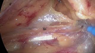 Передняя резекция прямой кишки. Anterior resection for rectal cancer.