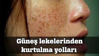 İşte Güneş Lekelerinden Kurtulmanın Yolları