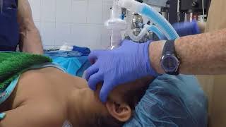 5-16. Ventilating a Child