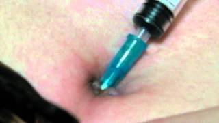 MAI~2 navel needle stab