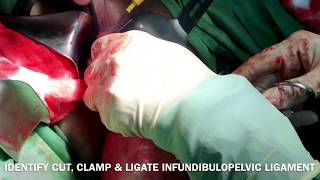 TOTAL ABDOMINAL HYSTERECTOMY PART 3 MYOMA UTERI