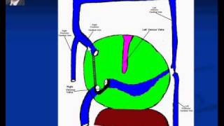 Embryology of the heart; Sinus Venosus (in Arabic)