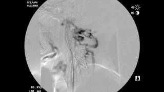 CCSVI Procedure 3