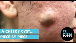 A Cheeky Cyst... Piece by Piece