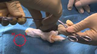 Dorsal slit Male Circumcision