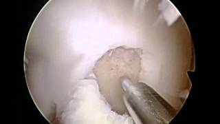 OCD Lesion – Knee Arthroscopy with Cartilage Repair and Regeneration