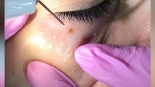 Удаление милиумов (жировиков) аппаратом Плекср. ☎️0502130677 Dermatoloq Shamsiyya Rahimzade