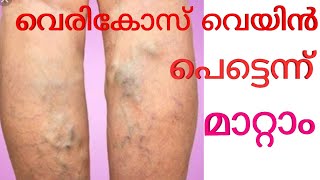 വെരിക്കോസ് വെയിൻ പൂർണമായും എളുപ്പത്തിൽ മാറ്റാം /natural home remedies for varikose veyin