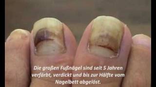 Gelbliche Zehennägel? Dicker Fußnagel? Fußnägel richtig schneiden.