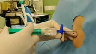硬膜外麻酔 epidural anesthesia