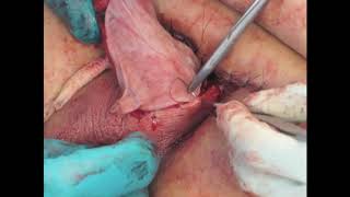 Adult Buried Penis Repair