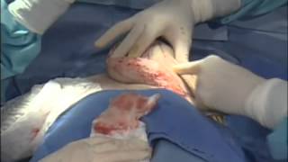 Breast Lift Mastopexy Surgery