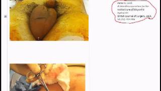 Hydrocele Lords Procedure