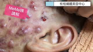 「枚桂」B先生針清4