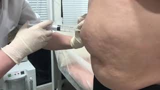 Озонотерапия для коррекции области живота