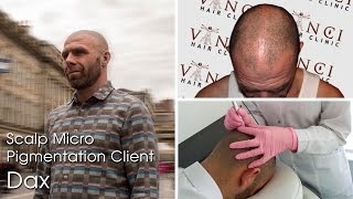Hair Tattoo Glasgow - Vinci SMP Glasgow