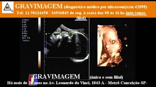 GRAVIMAGEM 21294 Ultrassom em gravidez com 29 semanas