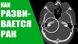 Как развивается рак