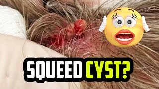 Squeed:  Cyst or Spider Bite?  What is it?