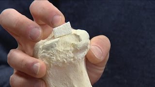 Un implant céramique contenant des antibiotiques pour la chirurgie orthopédique