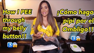 How I PEE through my belly button paralyzed! Mitrofanoff info! ¡Cómo hago pipí por el ombligo en ♿️!