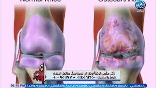 قرحة وتآكل الركبة يؤدي الى تدمير نصف مفاصل الجسم