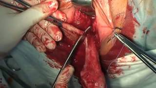 Utero vaginal prolapse vaginal hysterectomy