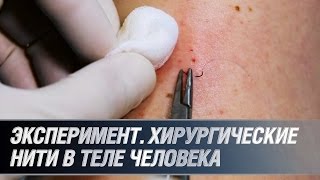 Эксперимент. Хирургические нити в теле человека