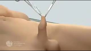 #Sünnət - #Циркумцизия - #Обрезание