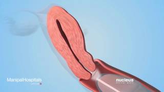 EDUCATIONAL VIDEO ABOUT SEX:How to use male condom properly,   Manipal Hospitals