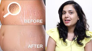 ಸ್ಟ್ರೆಚ್ ಮಾರ್ಕ್ಸ್ ಇದೆಯಾ? | How To Remove Stretch Marks - Quick & Easy Solution