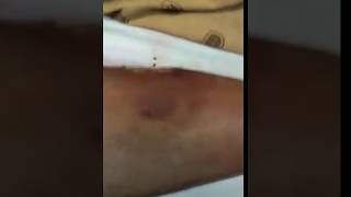 Infected Deep Wound caused by Biting by a Young Girl