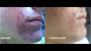 Ángel's Acne Treatment #1