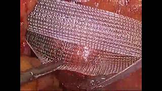 lap.High orchidectomy with transperitoneal mesh placement