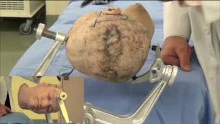Skull Clamp Placement: Temporal/Subtemporal Craniotomy-Pin Placement