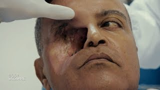 Défiguré à cause d’une tumeur faciale fulgurante ! (Body bizarre)