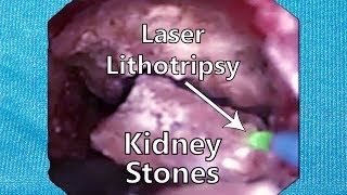 Kidney Stone Removal with Laser Lithotripsy
