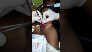 Khatan kanak-kanak Nigeria (6)umur 1thn lbh... Rilex jer...tak nangis langsung