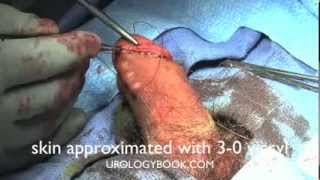 Copy of shapiro circumcision on urologybook.com